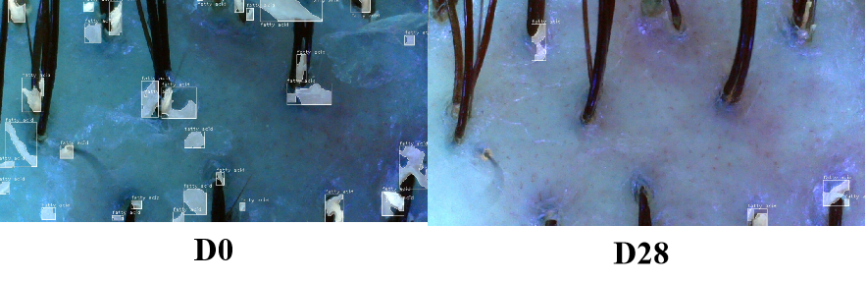 頭皮,健康,頭皮脫屑,頭皮皮脂